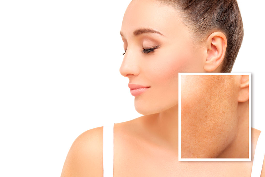 Tratamento Protocolo Clarify para controle de melasma realizado na Clínica Dra. Raquel Lobato em Porto Alegre.